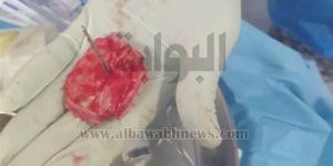 استخراج جسم معدني خطير من جمجمة طفل دون مضاعفات بمستشفى الفيوم الجامعي