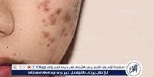 كيفية التخلص من آثار الحبوب.. مشكلة تؤرق الكثيرين