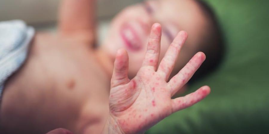 الأندلس تسجل ارتفاعاً في داء الحصبة