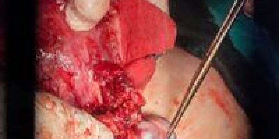لديها تاريخ مرضي..إنقاذ لحالة ولادة حرجة بمستشفى أشمون العام بالمنوفية