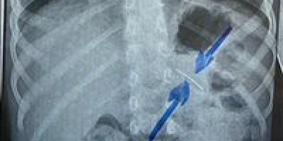 فريق طبي بـ"جامعة سوهاج" ينجح في استخراج دبوس من معدة طفل بالمنظار