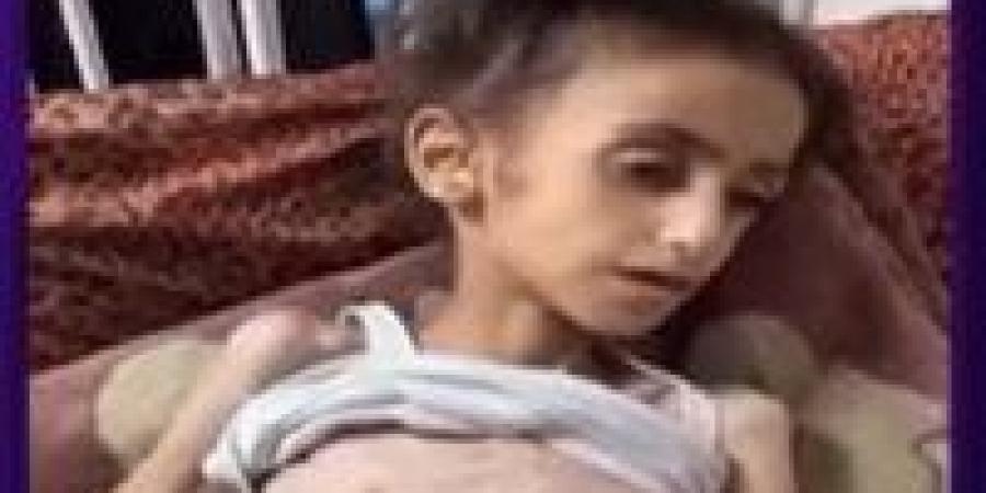 الأمم المتحدة: 1 من كل 5 أشخاص بغزة يواجه المجاعة