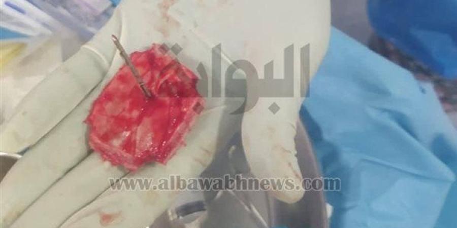 استخراج جسم معدني خطير من جمجمة طفل دون مضاعفات بمستشفى الفيوم الجامعي