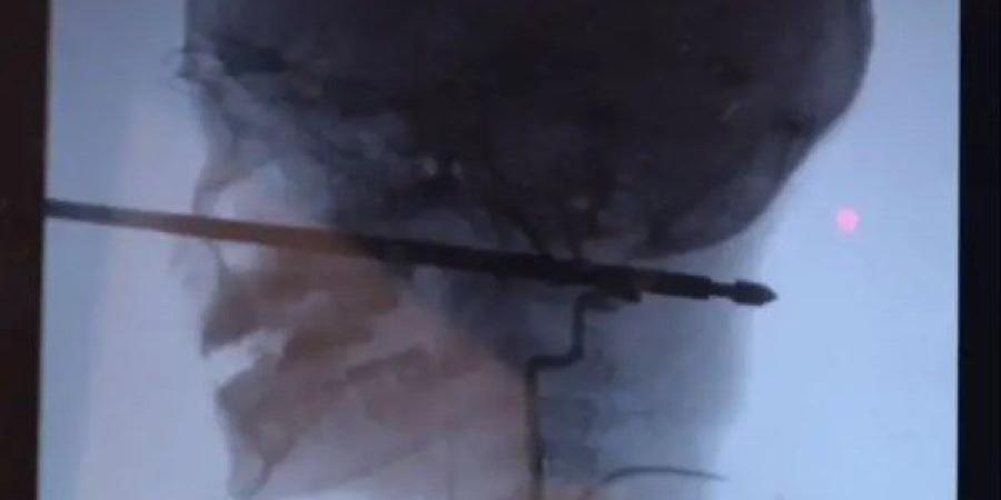 طفل يهشم رأس ابن خاله الرضيع فى خناقة مع والدته بالمعصرة