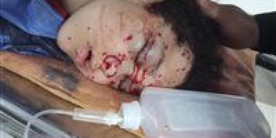 فتاة تصاب بطلق خرطوش في وجهها خلال حفل خطوبة في السنبلاوين
