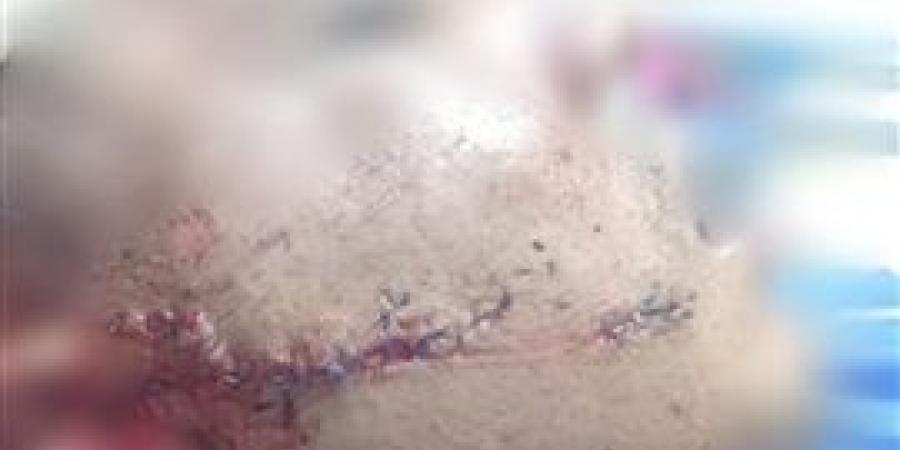 إنجاز طبي فريد بمستشفى صدر المنيا، إنقاذ شاب من إصابة خطيرة في الوجه